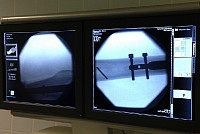 Test d'implantation allongement fémoral