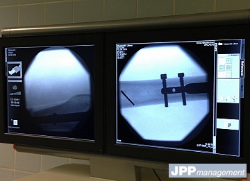 Test d'implantation allongement fémoral