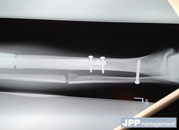 Allongement du tibia