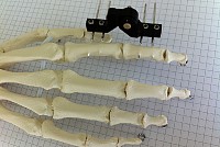 fixateur externe Gexfix