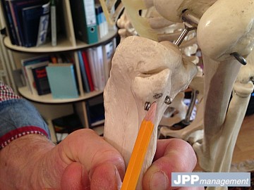 etude implantation tibiale