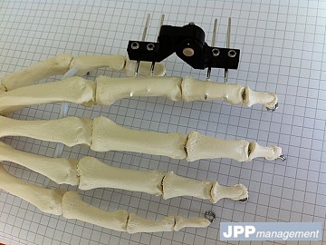 fixateur externe Gexfix